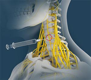Image Name - Stellate Ganglion Block Image Name - Stellate Ganglion Block